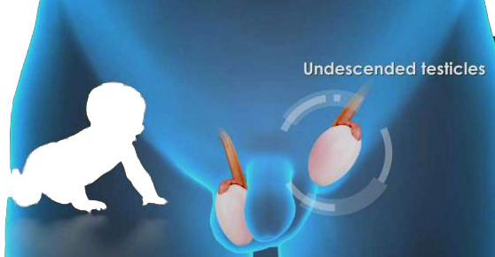 Undescended testes