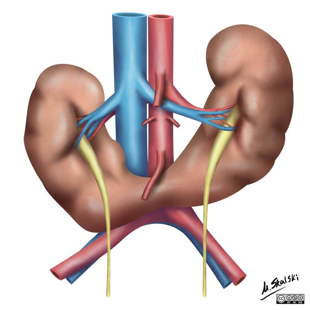 Congenital kidney abnormalities