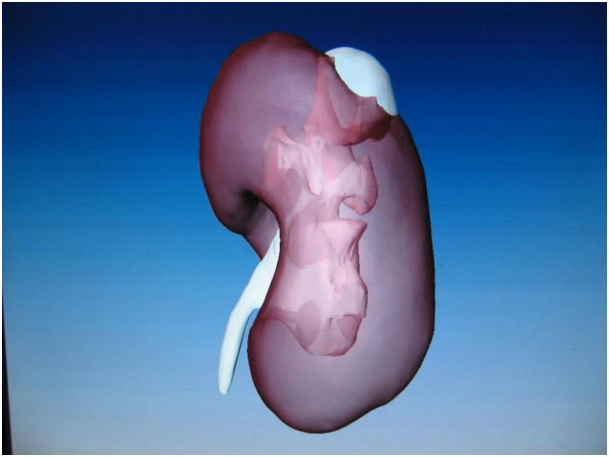 kidney cyst